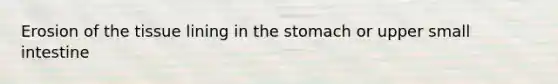 Erosion of the tissue lining in the stomach or upper small intestine