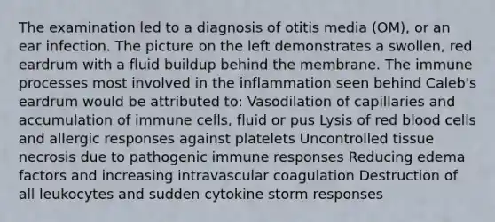 The examination led to a diagnosis of otitis media (OM), or an ear infection. The picture on the left demonstrates a swollen, red eardrum with a fluid buildup behind the membrane. The immune processes most involved in the inflammation seen behind Caleb's eardrum would be attributed to: Vasodilation of capillaries and accumulation of immune cells, fluid or pus Lysis of red blood cells and allergic responses against platelets Uncontrolled tissue necrosis due to pathogenic immune responses Reducing edema factors and increasing intravascular coagulation Destruction of all leukocytes and sudden cytokine storm responses