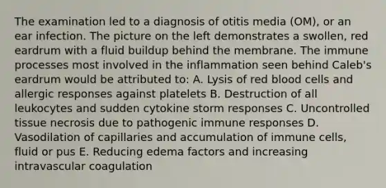 The examination led to a diagnosis of otitis media (OM), or an ear infection. The picture on the left demonstrates a swollen, red eardrum with a fluid buildup behind the membrane. The immune processes most involved in the inflammation seen behind Caleb's eardrum would be attributed to: A. Lysis of red blood cells and allergic responses against platelets B. Destruction of all leukocytes and sudden cytokine storm responses C. Uncontrolled tissue necrosis due to pathogenic immune responses D. Vasodilation of capillaries and accumulation of immune cells, fluid or pus E. Reducing edema factors and increasing intravascular coagulation