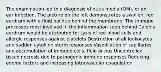 The examination led to a diagnosis of otitis media (OM), or an ear infection. The picture on the left demonstrates a swollen, red eardrum with a fluid buildup behind the membrane. The immune processes most involved in the inflammation seen behind Caleb's eardrum would be attributed to: Lysis of red blood cells and allergic responses against platelets Destruction of all leukocytes and sudden cytokine storm responses Vasodilation of capillaries and accumulation of immune cells, fluid or pus Uncontrolled tissue necrosis due to pathogenic immune responses Reducing edema factors and increasing intravascular coagulation