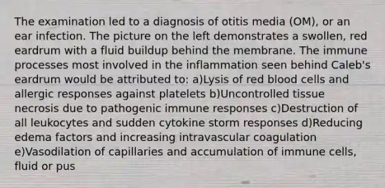 The examination led to a diagnosis of otitis media (OM), or an ear infection. The picture on the left demonstrates a swollen, red eardrum with a fluid buildup behind the membrane. The immune processes most involved in the inflammation seen behind Caleb's eardrum would be attributed to: a)Lysis of red blood cells and allergic responses against platelets b)Uncontrolled tissue necrosis due to pathogenic immune responses c)Destruction of all leukocytes and sudden cytokine storm responses d)Reducing edema factors and increasing intravascular coagulation e)Vasodilation of capillaries and accumulation of immune cells, fluid or pus