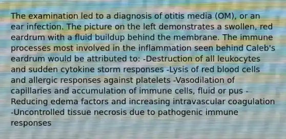 The examination led to a diagnosis of otitis media (OM), or an ear infection. The picture on the left demonstrates a swollen, red eardrum with a fluid buildup behind the membrane. The immune processes most involved in the inflammation seen behind Caleb's eardrum would be attributed to: -Destruction of all leukocytes and sudden cytokine storm responses -Lysis of red blood cells and allergic responses against platelets -Vasodilation of capillaries and accumulation of immune cells, fluid or pus -Reducing edema factors and increasing intravascular coagulation -Uncontrolled tissue necrosis due to pathogenic immune responses
