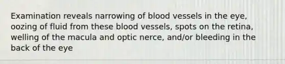 Examination reveals narrowing of blood vessels in the eye, oozing of fluid from these blood vessels, spots on the retina, welling of the macula and optic nerce, and/or bleeding in the back of the eye