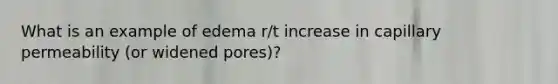 What is an example of edema r/t increase in capillary permeability (or widened pores)?