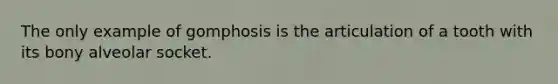 The only example of gomphosis is the articulation of a tooth with its bony alveolar socket.