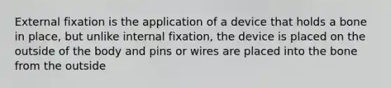 External fixation is the application of a device that holds a bone in place, but unlike internal fixation, the device is placed on the outside of the body and pins or wires are placed into the bone from the outside