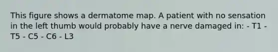 This figure shows a dermatome map. A patient with no sensation in the left thumb would probably have a nerve damaged in: - T1 - T5 - C5 - C6 - L3