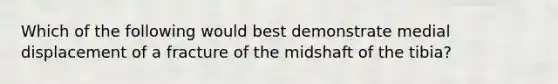 Which of the following would best demonstrate medial displacement of a fracture of the midshaft of the tibia?