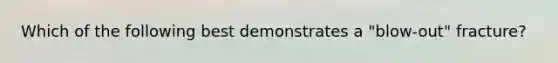 Which of the following best demonstrates a "blow-out" fracture?