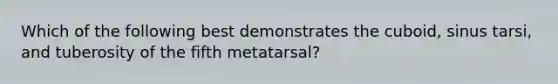 Which of the following best demonstrates the cuboid, sinus tarsi, and tuberosity of the fifth metatarsal?