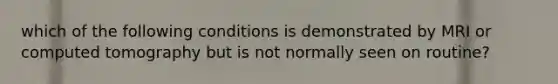 which of the following conditions is demonstrated by MRI or computed tomography but is not normally seen on routine?