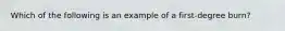 Which of the following is an example of a first-degree burn?