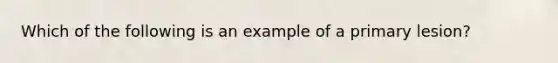 Which of the following is an example of a primary lesion?