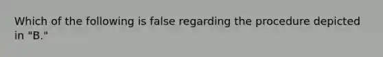 Which of the following is false regarding the procedure depicted in "B."