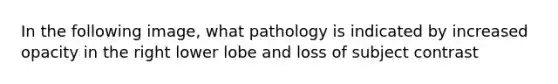 In the following image, what pathology is indicated by increased opacity in the right lower lobe and loss of subject contrast