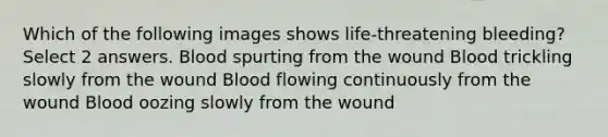 Which of the following images shows life-threatening bleeding? Select 2 answers. Blood spurting from the wound Blood trickling slowly from the wound Blood flowing continuously from the wound Blood oozing slowly from the wound