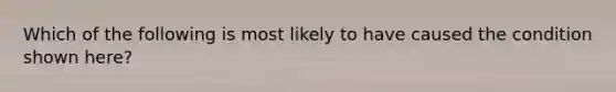 Which of the following is most likely to have caused the condition shown here?