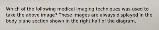 Which of the following medical imaging techniques was used to take the above image? These images are always displayed in the body plane section shown in the right half of the diagram.