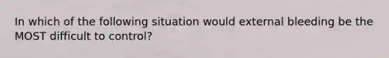 In which of the following situation would external bleeding be the MOST difficult to control?