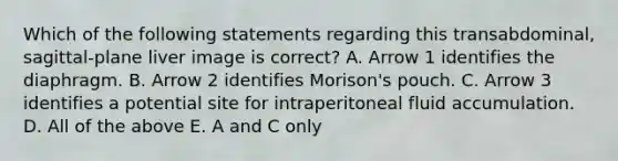 Which of the following statements regarding this transabdominal, sagittal-plane liver image is correct? A. Arrow 1 identifies the diaphragm. B. Arrow 2 identifies Morison's pouch. C. Arrow 3 identifies a potential site for intraperitoneal fluid accumulation. D. All of the above E. A and C only