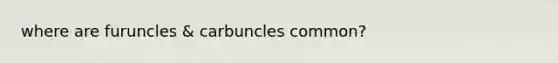 where are furuncles & carbuncles common?