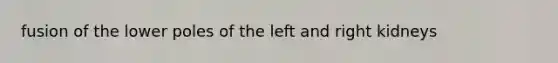 fusion of the lower poles of the left and right kidneys
