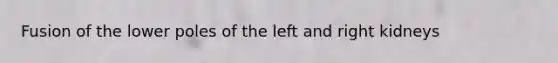 Fusion of the lower poles of the left and right kidneys