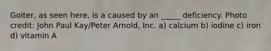 Goiter, as seen here, is a caused by an _____ deficiency. Photo credit: John Paul Kay/Peter Arnold, Inc. a) calcium b) iodine c) iron d) vitamin A