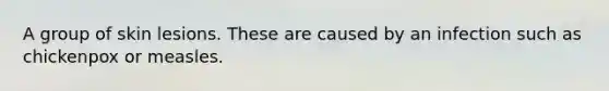 A group of skin lesions. These are caused by an infection such as chickenpox or measles.