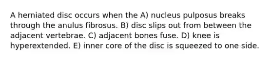 A herniated disc occurs when the A) nucleus pulposus breaks through the anulus fibrosus. B) disc slips out from between the adjacent vertebrae. C) adjacent bones fuse. D) knee is hyperextended. E) inner core of the disc is squeezed to one side.