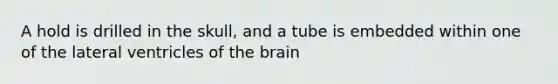 A hold is drilled in the skull, and a tube is embedded within one of the lateral ventricles of the brain