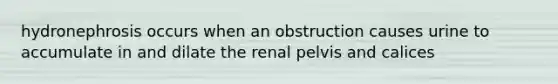 hydronephrosis occurs when an obstruction causes urine to accumulate in and dilate the renal pelvis and calices