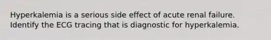 Hyperkalemia is a serious side effect of acute renal failure. Identify the ECG tracing that is diagnostic for hyperkalemia.