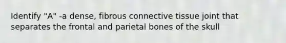 Identify "A" -a dense, fibrous connective tissue joint that separates the frontal and parietal bones of the skull