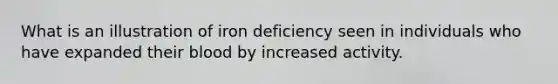 What is an illustration of iron deficiency seen in individuals who have expanded their blood by increased activity.