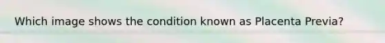 Which image shows the condition known as Placenta Previa?
