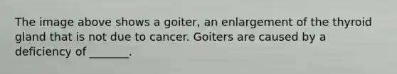 The image above shows a goiter, an enlargement of the thyroid gland that is not due to cancer. Goiters are caused by a deficiency of _______.