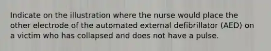 Indicate on the illustration where the nurse would place the other electrode of the automated external defibrillator (AED) on a victim who has collapsed and does not have a pulse.