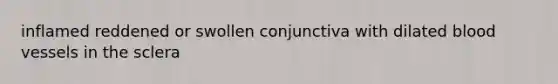 inflamed reddened or swollen conjunctiva with dilated <a href='https://www.questionai.com/knowledge/kZJ3mNKN7P-blood-vessels' class='anchor-knowledge'>blood vessels</a> in the sclera