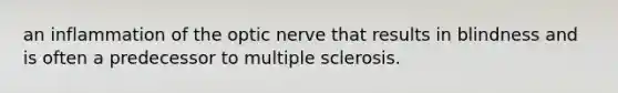 an inflammation of the optic nerve that results in blindness and is often a predecessor to multiple sclerosis.