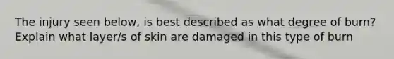 The injury seen below, is best described as what degree of burn? Explain what layer/s of skin are damaged in this type of burn