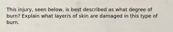 This injury, seen below, is best described as what degree of burn? Explain what layer/s of skin are damaged in this type of burn.