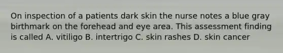 On inspection of a patients dark skin the nurse notes a blue gray birthmark on the forehead and eye area. This assessment finding is called A. vitiligo B. intertrigo C. skin rashes D. skin cancer