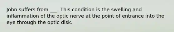 John suffers from ___. This condition is the swelling and inflammation of the optic nerve at the point of entrance into the eye through the optic disk.