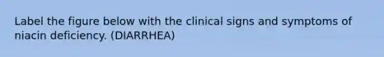 Label the figure below with the clinical signs and symptoms of niacin deficiency. (DIARRHEA)