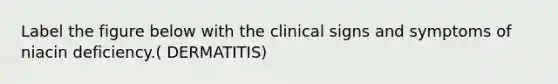 Label the figure below with the clinical signs and symptoms of niacin deficiency.( DERMATITIS)