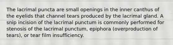 The lacrimal puncta are small openings in the inner canthus of the eyelids that channel tears produced by the lacrimal gland. A snip incision of the lacrimal punctum is commonly performed for stenosis of the lacrimal punctum, epiphora (overproduction of tears), or tear film insufficiency.