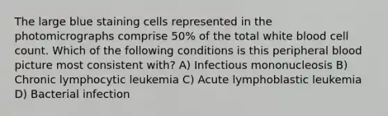 The large blue staining cells represented in the photomicrographs comprise 50% of the total white blood cell count. Which of the following conditions is this peripheral blood picture most consistent with? A) Infectious mononucleosis B) Chronic lymphocytic leukemia C) Acute lymphoblastic leukemia D) Bacterial infection