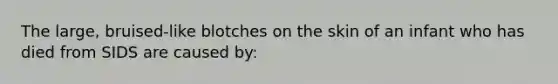 The large, bruised-like blotches on the skin of an infant who has died from SIDS are caused by: