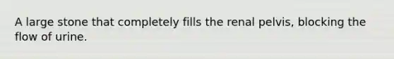 A large stone that completely fills the renal pelvis, blocking the flow of urine.